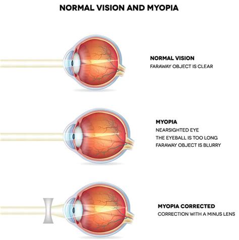 Myopia Control Yukon Eyecare