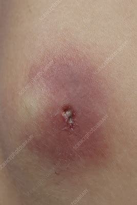 Abscess Stock Image C Science Photo Library