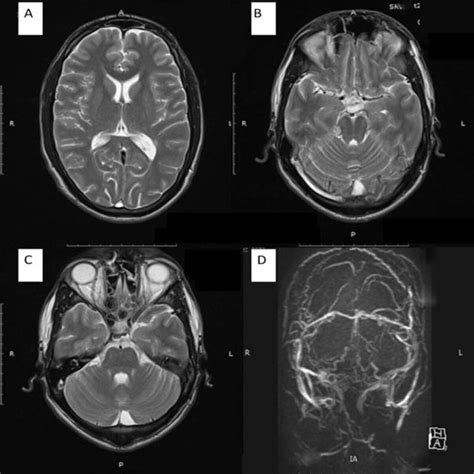 Ct Brain Showing Right Temporal Lobe Hypodensity Mri Brain T2