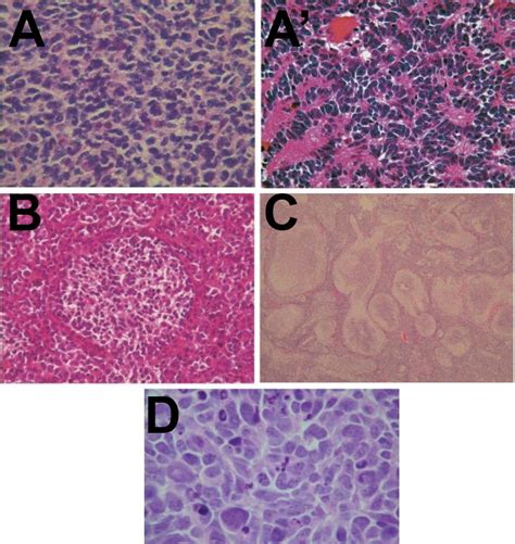 Histopathological Types Of Medulloblastoma According To The Who