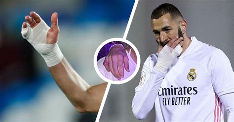 La Grande Histoire Du Petit Doigt De Karim Benzema La Meringue