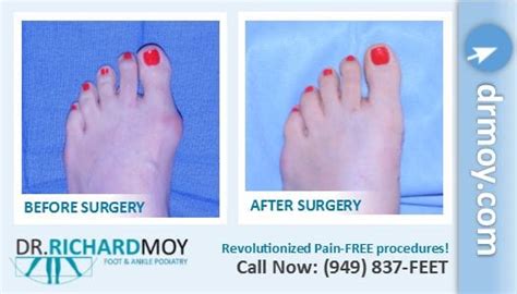 Dr Richard Moy Dpm Painless Bunion Surgery Board Certified Surgeon