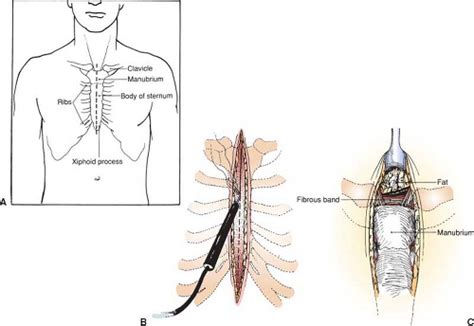 Median Sternotomy And Thymectomy Basicmedical Key