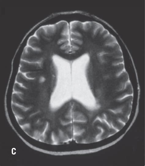 Extrapulmonary Sarcoidosis Consultant