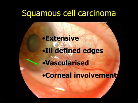 Ppt Ocular Oncology Powerpoint Presentation Free Download Id4545171