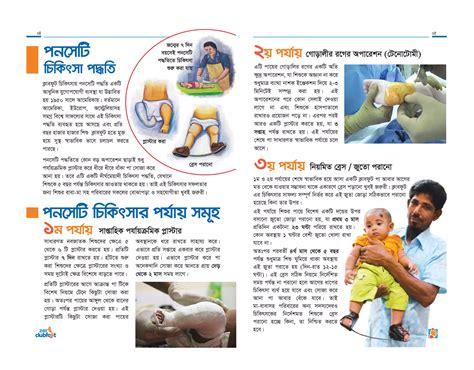 Clubfoot Treatment Guideline | PDF
