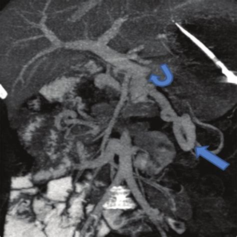 Axial Contrast Enhanced Computed Tomography Shows Whirlpool Sign