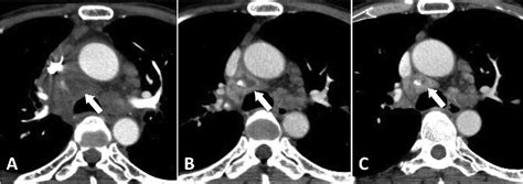 Figure From Development Of Mediastinal Adenitis Six Weeks After