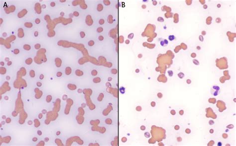 Rbc Agglutination Test