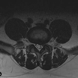 A 23‐year‐old male patient. Anteroposterior X‐ray of the lumbar ...