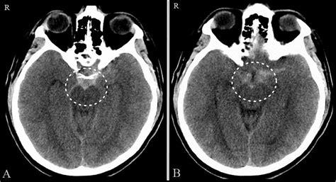 Familial Perimesencephalic Subarachnoid Hemorrhage Two Case Reports