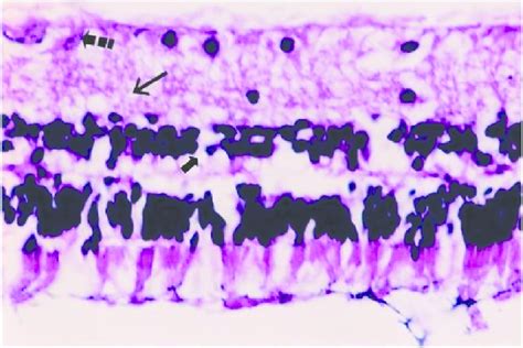 Drug Histological Photograph Of Hydropic Degeneration Of A Few