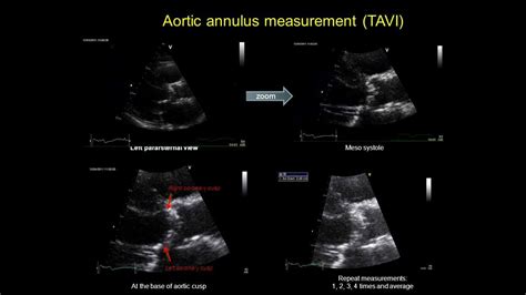 Aortic Annulus Measurement