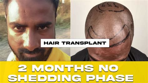 My Months Transplant Result No Shedding Phase Days After Hair