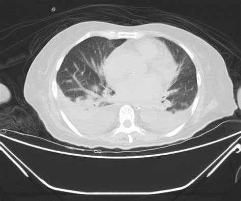 Ct Examination Images On 20 April Showed Bilateral Pleural Effusion Download Scientific