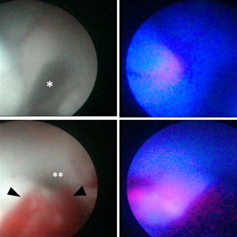 Intraoperative Findings Of Case A Endoscopic Photographs Of The