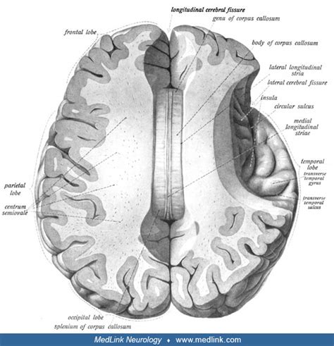 Central Deafness Medlink Neurology