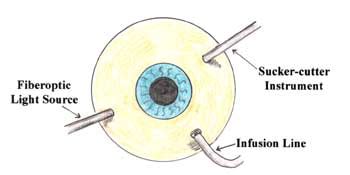 Safest Vitrectomy Procedure for Eye Floaters Treatment | eye floaters ...