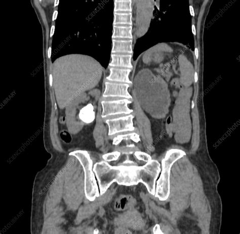 Kidney stone, CT scan - Stock Image - F041/9024 - Science Photo Library