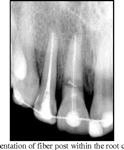 Figure 5 From Conservative Treatment Of A Horizontal Root Fracture In A Maxillary Central