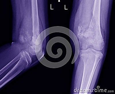 X Ray Knee Join Showing Large Osteolytic Lesuion Of Medial Aspect Of