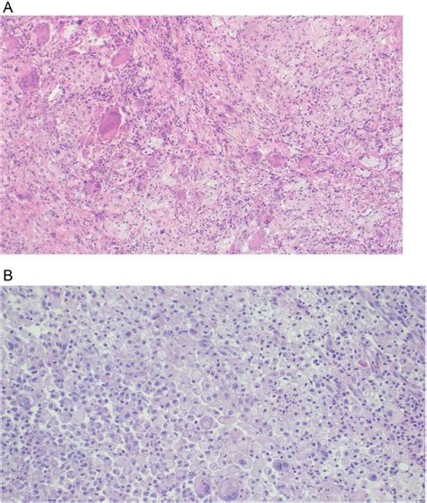 A: Histopathology of the kidney specimen highlighting replacement of ...