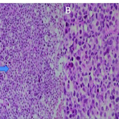 Diffuse large atypical lymphoid cells. A: H and E; 200X (blue arrow ...