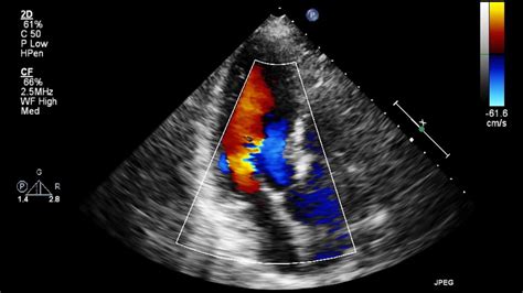 Echocardiogram Heart Ultrasound Vs