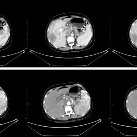 Imaging Findings A Abdominal Enhanced Computed Tomography Ct In