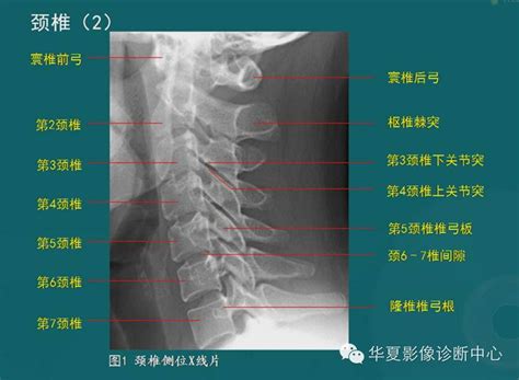 脊柱检查之x线、ct、mri影像解剖 好医术早读文章 好医术 赋能医生守护生命