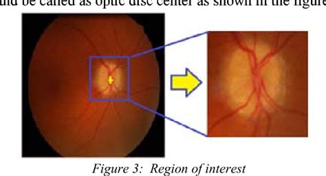 Figure From Glaucoma Detection Through Optic Disc And Cup