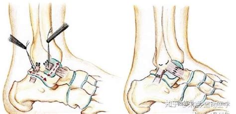 关节镜下伸肌下支持带增强联合broström技术治疗踝关节陈旧性不稳 知乎