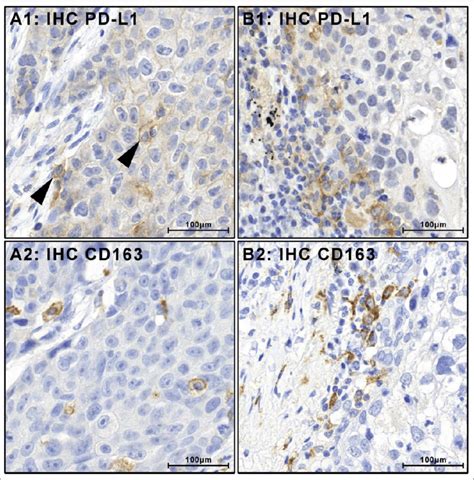 Tumor Associated PD L1 Positive Immune Cells Stain Positive For