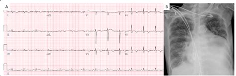 Electrocardiogram And Chest X Ray A Electrocardiogram Shows Normal