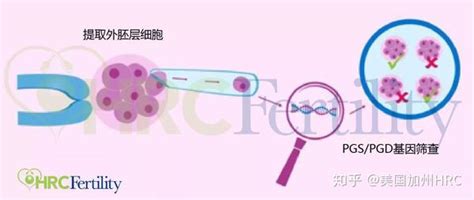 Hrc课堂 胚胎等级 Vs Pgs Pgd，哪个才是衡量胚胎移植的最佳标准？ 知乎