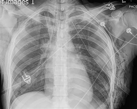 Penetrating Chest Injury 2017 08 03 Ahc Media Relias Media