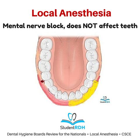 Q: The mental nerve block anesthetizes the: - StudentRDH Blog