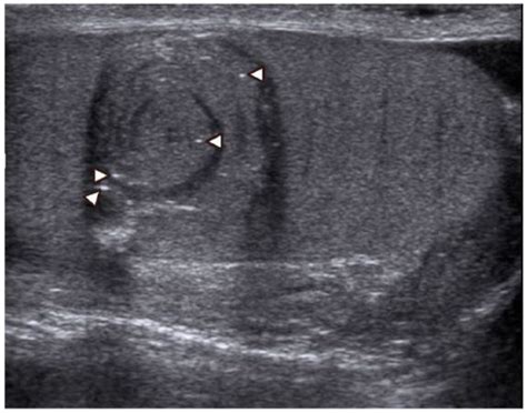 Epidermoid Cyst Of The Testis Sonographic Characteristic Appearance