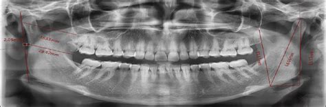Mandibular Morphometric Analysis For Sex Assessment A Retro Journal Of Indian Academy Of