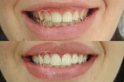 Sorriso Gengival Tratamento Antes E Depois Kb Implart