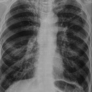 CT scan demonstrating giant bullae with compression of the lung parenchyma | Download Scientific ...