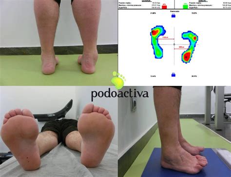 Blog de Podoactiva Últimas noticias de podología y consejos sobre