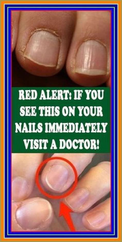 8 Important Signs Your Fingernails Artofit