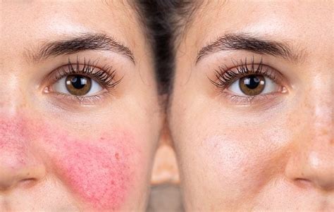 Gambar Penyakit Rosacea