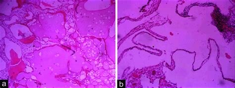 (a) Histologic section showing multilocular cyst containing lymphocytes ...