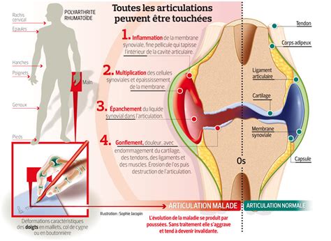 Rhumatisme inflammatoire découvrez cette maladie des articulations