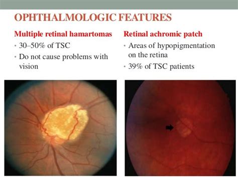 Neurocutaneous syndrome