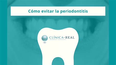 C Mo Evitar La Periodontitis