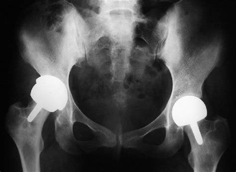 Bilateral Metal On Metal Hip Resurfacing In A Year Old Patient With