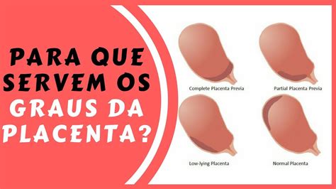 O Que Significa Placenta Grau 1 - Placenta Grau 1 De Grannum - RETOEDU